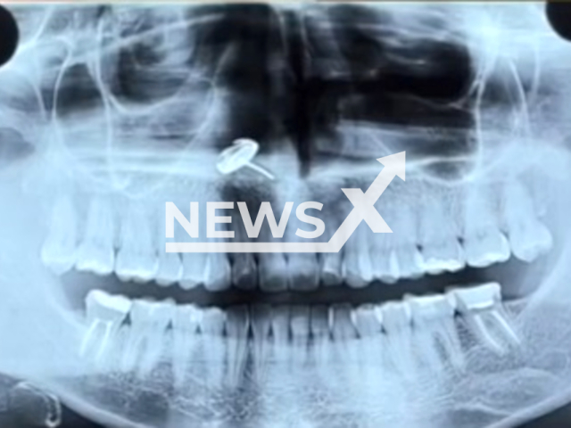 Picture shows an X-ray of the teeth of Brazilian Fernanda Coquete, undated. She found an earring inside her nose. Note: Private photo. (@eufernandacoquete/Newsflash)