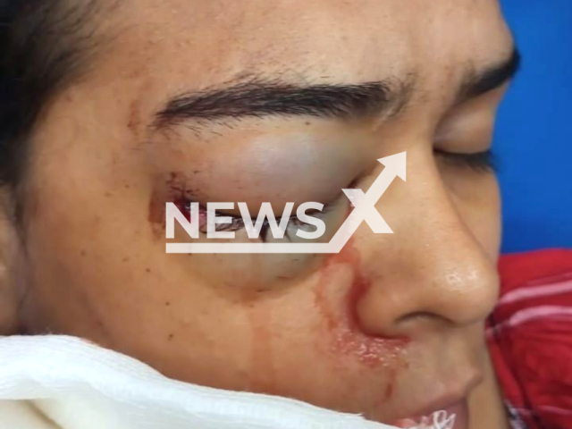 Picture shows the injured Ketlheen Renata Costa Rocha, undated. She was hit by a target pellet in the eye in Manaus, Brazil. Note: Private photo. (Newsflash)