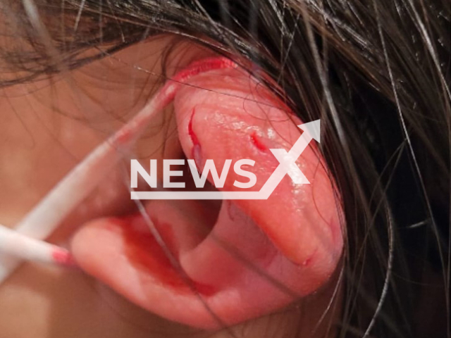 Photo shows the injury of the girl attacked by a Cockatoo at  Mandai Bird Paradise in Singapore. The ear of the 13-year old girl was bleeding and had torn skin.
Note: Private photo(@furylin/Newsflash).