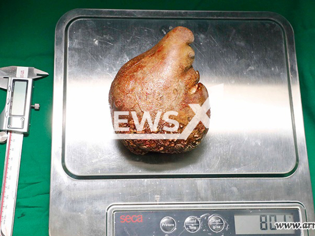 Photo shows the world's largest kidney stone removed from a 62-year-old retired soldier by the Sri Lankan army doctors at the Colombo Army Hospital in Colombo, Sri Lanka, on June 1, 2023. According to the army, the stone weighed more than five times the weight of an average male kidney.Note: Photo is from the Sri Lanka Army (Sri Lanka Army/Newsflash)