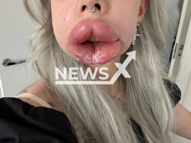 Photo shows the edema on the lips of Kristina Vishnivetskaya, known as Cartier Bugatti, undated. She was reportedly hospitalized following a lip injection which led to severe edema. Note: Picture is private (@gubatticartie/Newsflash)