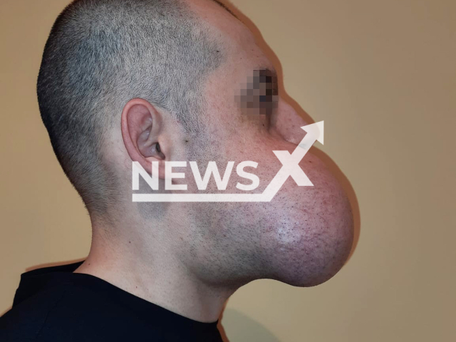 Picture shows Angelo, 38, before surgery, undated. A tumour weighing over a kilo has been removed from his jaw in Milan, Italy. Note: Photo obtained with permission. (Newsflash)