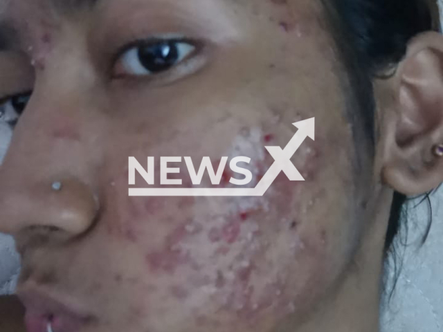 Photo shows the damaged face skin of a Malaysian woman, undated. She claims her skin was damaged after a facial treatment. 
Note: Private photo(@teaszn/Newsflash).