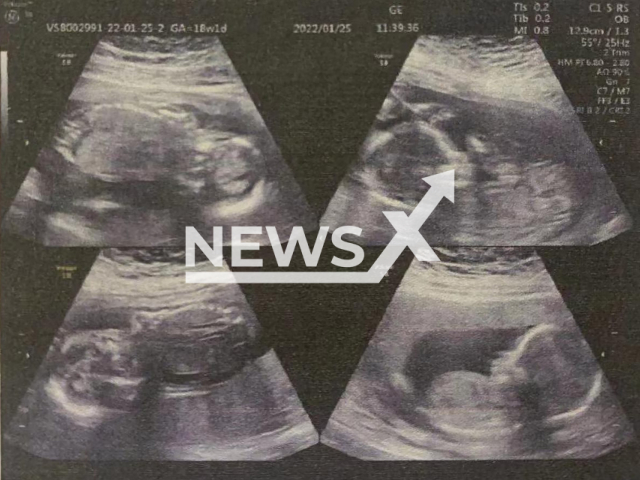 Ultrasound image of quadruplets - Pregnant woman, 22, gave birth to four babies in different months and days at Qilu Hospital of Shandong University in Jinan, China. Note: Hospital photo. (Qilu Hospital of Shandong University/AsiaWire)