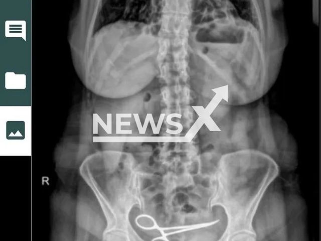 Photo shows the x-ray image of Sadiye Boyun, undated. A pair of scissors was left in the abdomen in Sadiye Boyun, after an operation at a hospital in Pursaklar, Ankara, Turkey. Note: Picture is private (Newsflash)