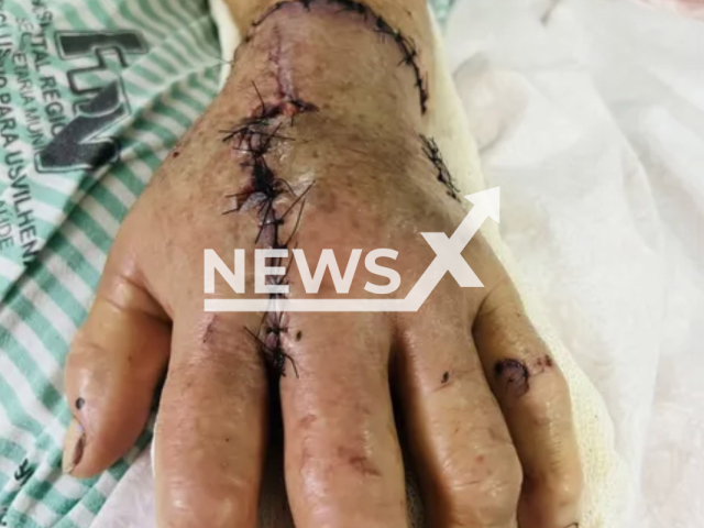 Photo shows the stitches on the hand of an elderly woman, undated. A 66-year-old woman received more than 60 stitches in her hand after being attacked by a tapir in Vilhena, Brazil. Note: Picture is private (Newsflash)