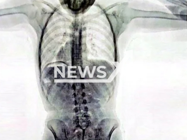 Photo shows Xray of the woman with the capsules of cocaine inside her body. She was arrested in the airport of Ezeiza, Buenos Aires, Argentina capital.
Notes: Private picture (Newsflash)