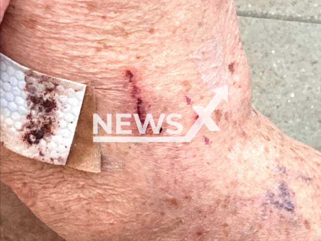 Photo shows the scratches on the body of the woman, 82, made by a bear in her home in Boncarbo, west of Trinidad in Colorado in August 2023. She declined medical attention for her scratches.
Note: Licensed photo(Colorado Parks and Wildlife/Newsflash).