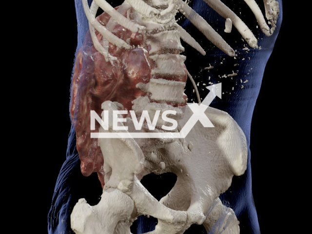 Image shows a 3D reconstruction of the patient's spine, undated photo. A team of medics from the town of Aarau, Switzerland, reconstructed a man's spine in a 25-hour-long surgery, undated photo. Note: Licensed content. (Aarau Cantonal Hospital/Newsflash)