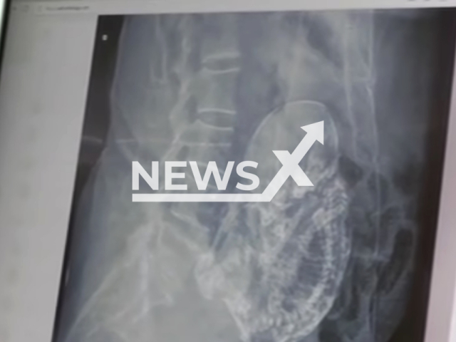 Photo shows an x-ray image that shows a case of Lithopedion, undated. Doctors reportedly found a mummified fetus in the womb of an 84-year-old woman in Durango, Mexico. Note: Picture is a screenshot from a video (Newsflash)