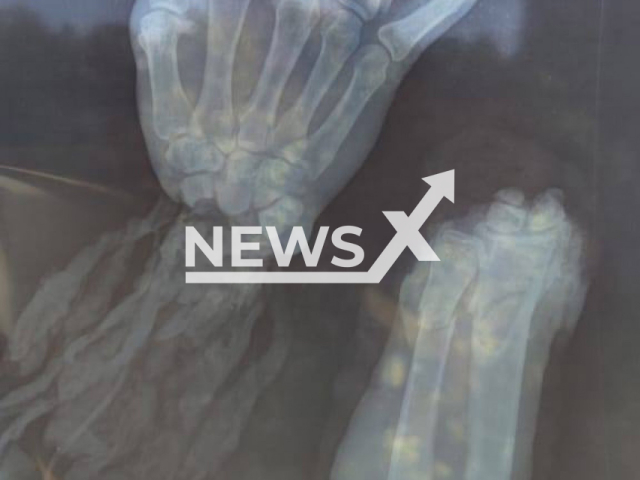 Photo shows x-ray image of the hand of a man, undated. A 35-year-old man's severed hand was sown back at a hospital in Moscow, Russia, after a cement mixer severed it. Note: Picture is private (Newsflash)