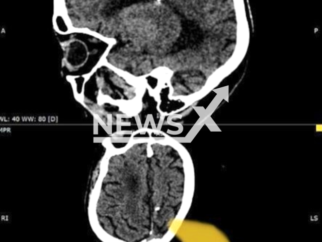 Picture shows X-ray a 3-centimeter needle in the brain of an 80-year-old pensioner in Sakhalin Oblast, Russia, undated. Pensioner woman lived with the needle whole life from birth. Note: Photo is obtained from the Ministry of Health of the Sakhalin Oblast. (@sakhalinminzdrav/Newsflash)