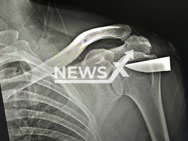 Photo shows the x-ray image of the shoulder of a man, undated. A six-centimeter-long fragment of a metal knife blade was removed from the man’s shoulder at a hospital in Mozhaysk, Russia. Note: Licensed photo (Russian Ministry of Health/Newsflash)