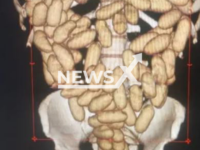 Picture shows X-ray images of capsules with cocaine inside the stomach of a suspect, undated.  Six passengers were arrested after being caught with cocaine capsules in their stomachs,  at Sao Paulo International Airport , in Guarulhos, Brazil, on Tuesday, Nov.14, 2023.
 Note: Private photo. (Newsflash)