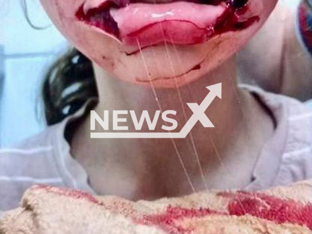 Picture shows injured Stephania, 7. Stray dog suddenly bit the girl in the face when she pet it near shop in Fyodorovsky settlement, Russia on Sunday, Nov. 12, 2023. Note: Private photo. (Newsflash)