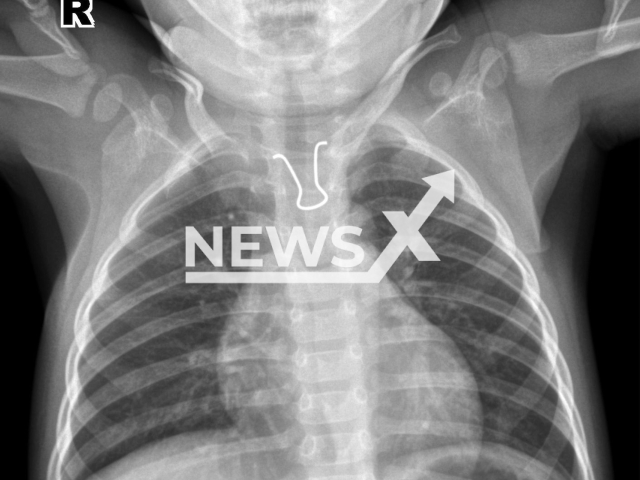 Baby boy swallows iron wire in Changsha, China. Note: Hospital photo. (Hunan Children's Hospital/AsiaWire)