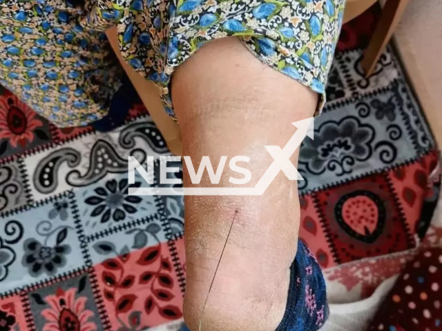 Photo shows a metal wire sticking out of the leg of a woman in Mugla, Turkey, undated. The 37 centimeters long wire was removed from the woman's leg. Note: Picture is private (Newsflash)