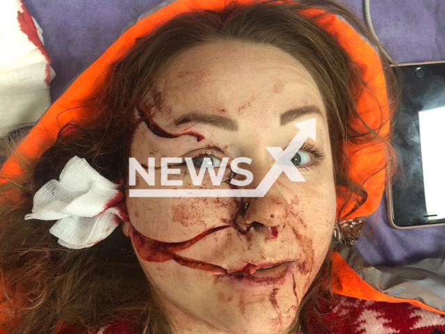 Ukrainian Anna Butim, 28, whose face was slashed with a box cutter by her then-husband Mesut Ozturkmen, 45, in Istanbul, Turkey on 15th January 2021. Note: Private picture (@AnnaButm1/Newsflash)