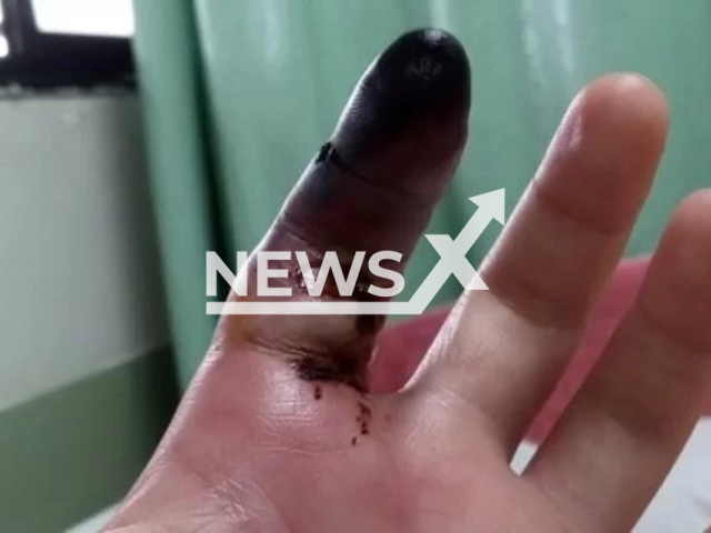 Photo shows the finger of Wilker Guimaraes, undated. He was stung by a brown spider while sleeping in Praia Grande, on the coast of Sao Paulo, Brazil, Dec. 28, 2023. Note: Picture is private (Newsflash)