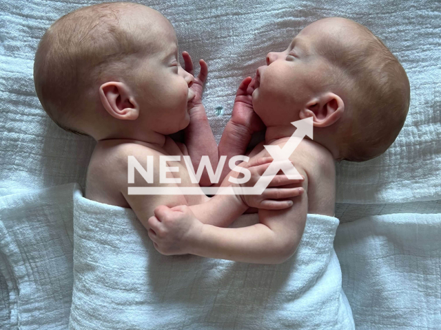 Photo shows the Conjoined twins, undated. The twin girls have been successfully separated at the Eppendorf University Hospital (UKE) in Hamburg.
Note: Licensed photo(University Hospital Hamburg-Eppendorf/Newsflash).