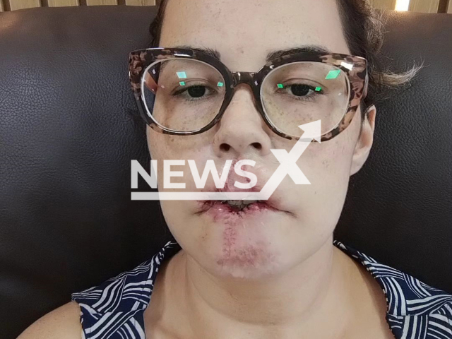 Picture shows influencer Mariana Michelini from Matao, Brazil, undated. She lost her upper lip after undergoing facial harmonization. Note: Private photo. (@mari_michelini/Newsflash)