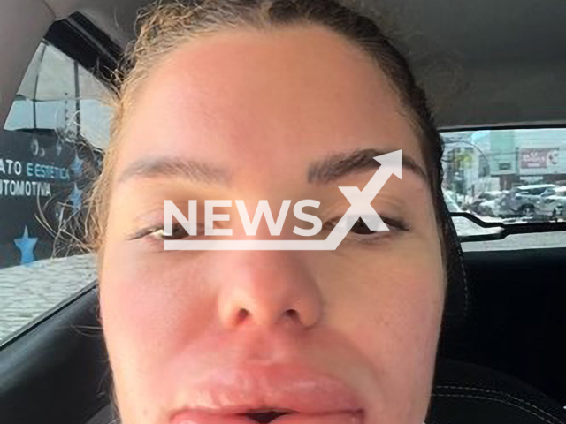 Picture shows Barbara Martiniano's lips after allergic reaction, undated. She underwent a procedure at an aesthetic clinic in João Pessoa in Brazil. Note: Private photo. (@barbara_martiniano/Newsflash)