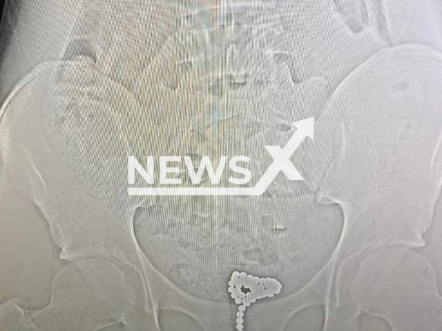 Photo shows X-ray of magnetic balls in a boy's urethra in Novorossiysk, Russia, undated. The teenager will spend about two weeks in hospital. Note: Note: Photo is from the Novorossiysk State Hospital (@gorbolnica1nvrsk/Newsflash)