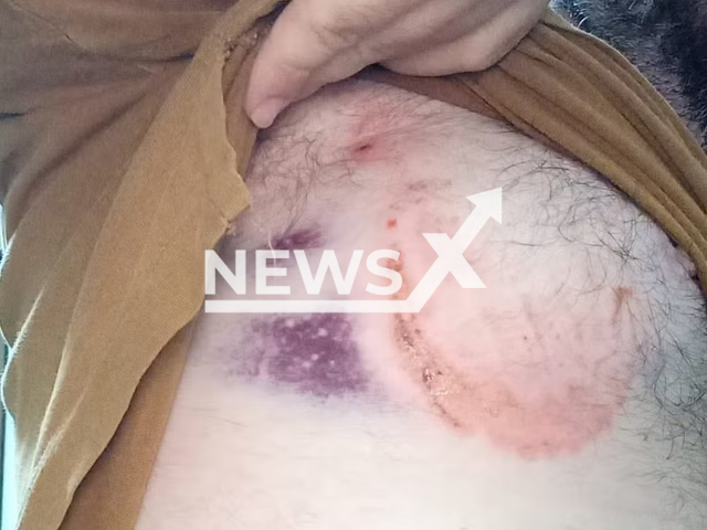 Photo shows the body of a man who was bitten by a horse in Sao Manoel do Parana, Brazil, Saturday, March 2, 2024. The man sustained injuries from the incident. Note: Picture is private (Newsflash)