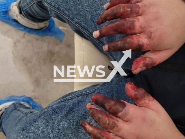 Photo shows the hands of a child who was subjected to violence by his father in Moscow, Russia. The father was sentenced to nine years in prison. Note: Picture is private (Newsflash)