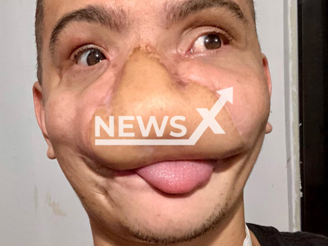 Samuel Rodrigues, 29, poses in undated photo. He lost part of his face after being hit by fireworks bomb in Caldas Novas, Brazil. Note: Private photo taken from social media. (@samcastkg/Newsflash)