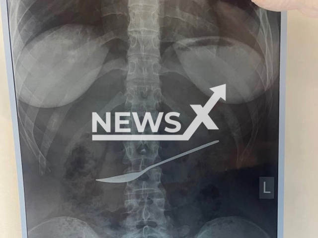 Photo shows X-ray of metal spoon inside patient's stomach in the Vologda State Regional Clinical Hospital, Russia, undated. Doctors removed the spoon. Note: Photo is obtained from the Vologda State Regional Clinical Hospital. (@vokb35/Newsflash)