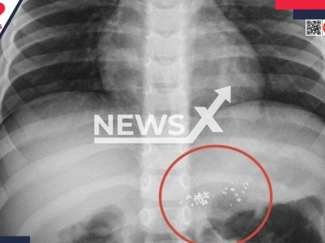 Photo shows X-ray of the stomach of patient boy in hospital of Novy Urengoy, Russia, undated.  The boy bit a thermometer and ate the mercury. Note: Photo is obtained from  the State budgetary healthcare institution of the Yamalo-Nenets Autonomous Okrug "Novy-Urengoy Central City Hospital". (@cgb-nur.yanao/Newsflash)