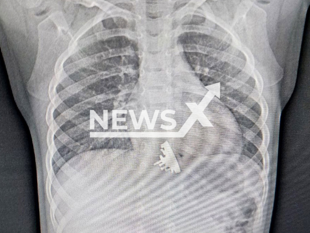 Photo shows X-ray of toy cruiser inside 2 years old patient's stomach in the Ivano-Matreninskaya Children’s Clinical Hospital, Irkutsk, Russia, undated. Doctors removed the cruiser. Note: Photo is obtained from City Ivano-Matreninskaya Children’s Clinical Hospital. (@imdkb.ru/Newsflash)