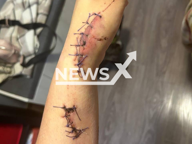 Photo shows injured arm of Valeria from Vladivostok, Russia, undated.  Her ex-boyfriend Anton bit and cut her hands. Note: Private photo taken from local media. (Newsflash)