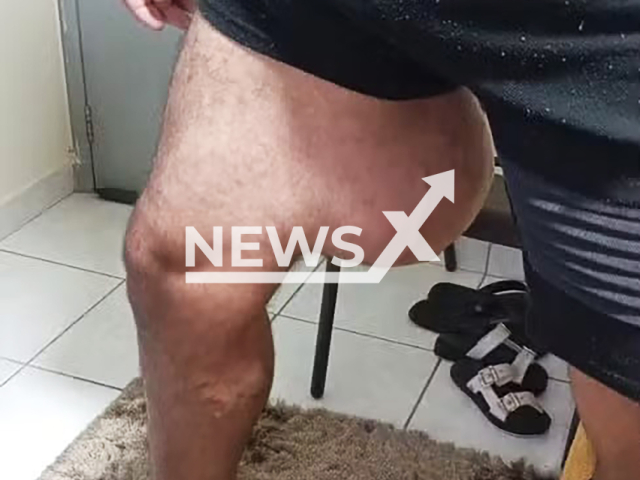 Picture shows man's tumor on his thigh in Praia Grance, SP in Brazil, undated. The tumor is reportedly he size of a child's head. Note: Private photo taken from local media. (Newsflash)