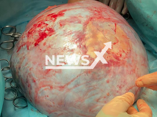 Surgeons remove a giant tumor from the left ovary of patient, 36, at Department of Oncogynecology, Oncology Center of Tomsk, Russia, undated. A woman complained of an increase in abdominal volume. Note: Photo is obtained from the State Regional Oncology Dispensary of Tomsk. (@oncodispanser/Newsflash)