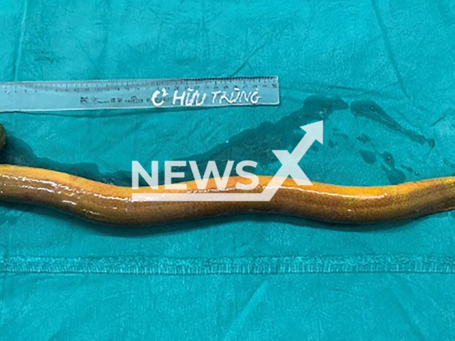 Picture shows the foreign objects removed from the patient's body in Hanoi, Vietnam, undated. A young man stuffed a live eel into his anus. Note: Hospital photo. (Newsflash)