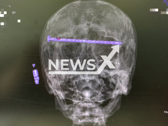 Photo shows X ray of a nail in the head of male patient, 78, at the City Hospital No. 1 in Nizhny Tagil, Sverdlovsk Oblast, Russia on Tuesday, July 30, 2024. The nail went through both eye sockets from the right to the left temple. Note: Photo is obtained from the Ministry of Health of the Sverdlovsk Region. (@minzdravso/Newsflash)