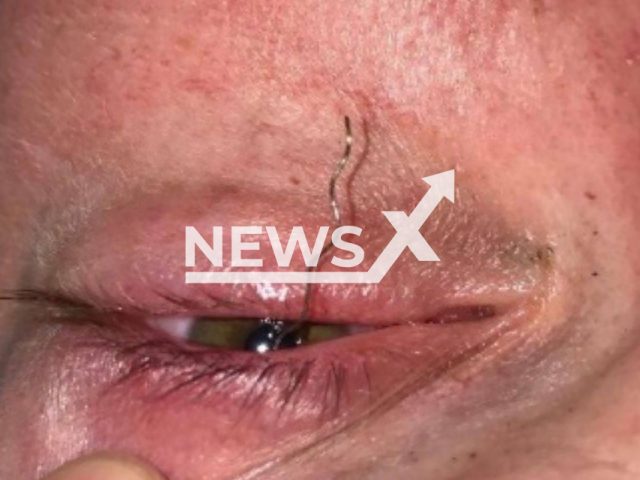 Photo shows a wire in the eye of male patient, 38, at Ophthalmology Department of Hospital in Istra, Moscow Oblast, Russia on Tuesday, July 30, 2024. He received the injury while installing plastic windows. Note: Photo is obtained from the Ministry of Health of the Moscow Region. (@minzdrav_mo/Newsflash)