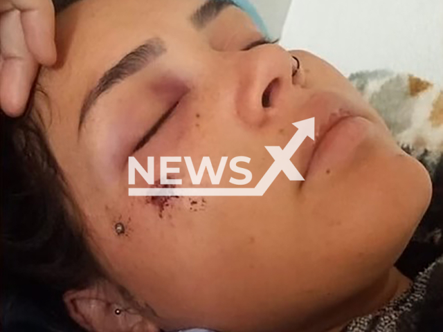 Picture shows pregnant Anny Gabrielly, 22, undated. She has a bullet in her face after being accidentally shot in Campo Grande, Brazil. Note: Private photo taken from local media. (Newsflash)