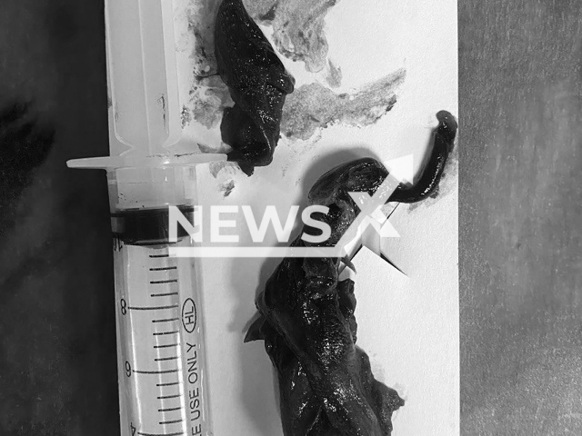 Photo shows a giant thrombus removed from a body of male patient, 76, in Moscow Regional Research Clinical Institute, Russia on Friday, Aug. 2, 2024. Doctors performed a thrombectomy on the man. Note: Licensed hospital photo. (@minzdrav_mo/Newsflash)