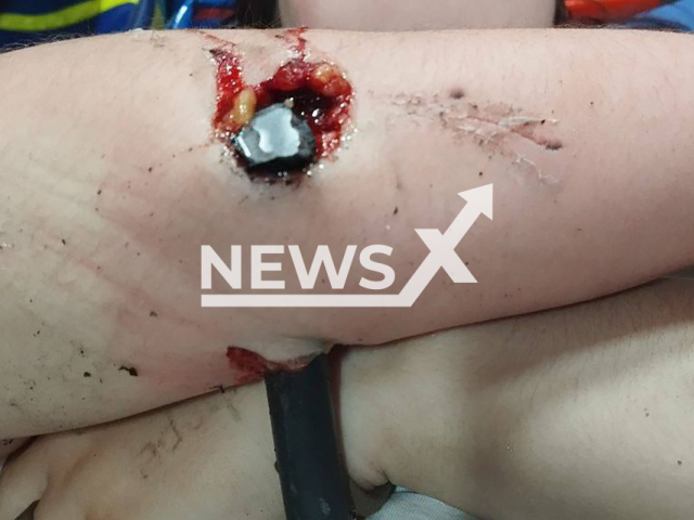 Photo shows the footrest of an electric scooter that pierced the arm of a teenage girl, 14, in Moscow, Russia, undated. The girl was hospitalized. Note: Photo is obtained from the Research Institute of Emergency Children's Surgery and Traumatology of the Moscow Department of Health "Roshal Clinic". (@roshal_clinic/Newsflash)