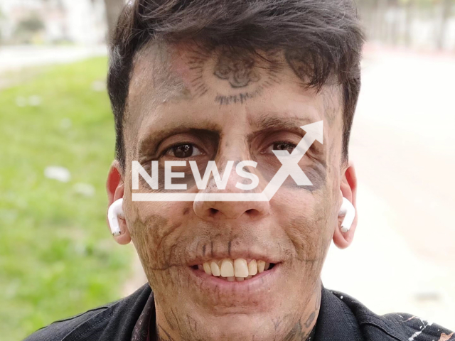 Picture shows Leandro de Souza after two sessions of tattoo removal, undated. He decided to remove his tattoos after becoming an evangelical. Note: Private photo taken from social media. (@leandrodesouzabless/Newsflash)