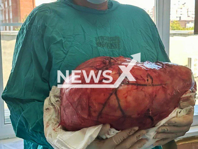 Photo shows a giant tumor from a male patient at the surgical department of the Regional Clinical Hospital No. 1 in Krasnodar, southern Russia on Tuesday, Aug. 6, 2024. The man had been ill for a year rapidly gaining weight. Note: Licensed hospital photo. (Evgeniy Filippov/Newsflash)