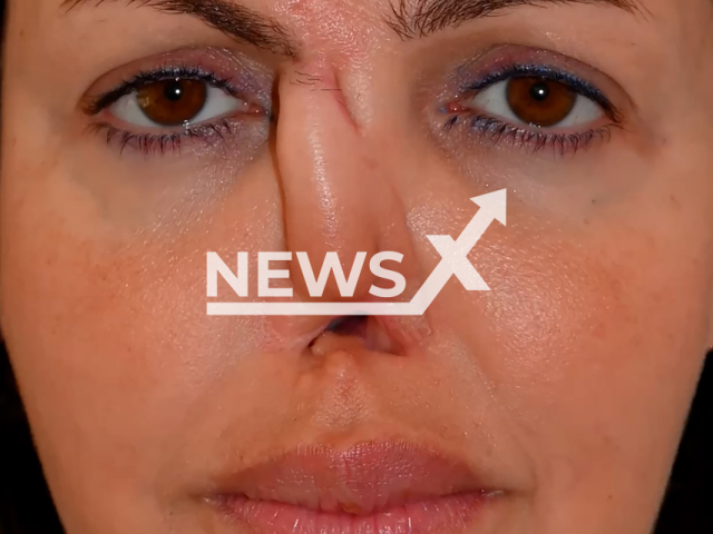 Footage shows Alisa Kazmina's nose reconstruction process during 9 operations made by surgeon Denis Agapov from Saint Petersburg, Russia on Tuesday, Aug. 6, 2024. There are still about 3 stages of her nose reconstruction ahead. Note: Photo is a screenshot from a video. (Surgeon Denis Agapov/Newsflash)