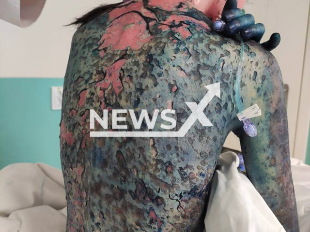 Photo shows a back of female patient, 15, at allergology department of the Republican Children's Clinical Hospital in Ufa, Bashkortostan, Russia on Thursday, Aug. 8, 2024. The girl had the toxic epidermal necrolysis (TEN), also known as Lyell's syndrome, a type of severe skin reaction. Note: Licensed hospital photo. (@DrRakhmatullin/Newsflash)