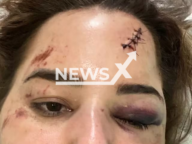 Picture shows injured Karine Brock, undated. She was thrown from a children's roller coaster in Alem Paraiba, Brazil. Note: Private photo taken from local media. (@karinebrock/Newsflash)