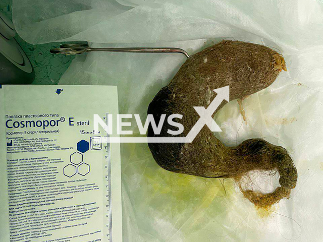 Photo shows a hairball pulled from the stomach of a female patient, 16, at Morozov Children's City Clinical Hospital in Moscow, Russia on Friday, Aug. 23, 2024. The schoolgirl developed a hair clot in her intestinal tract due to Rapunzel syndrome, a habit of chewing the ends of her hair. Note: Hospital photo. (@dzdmos/Newsflash)