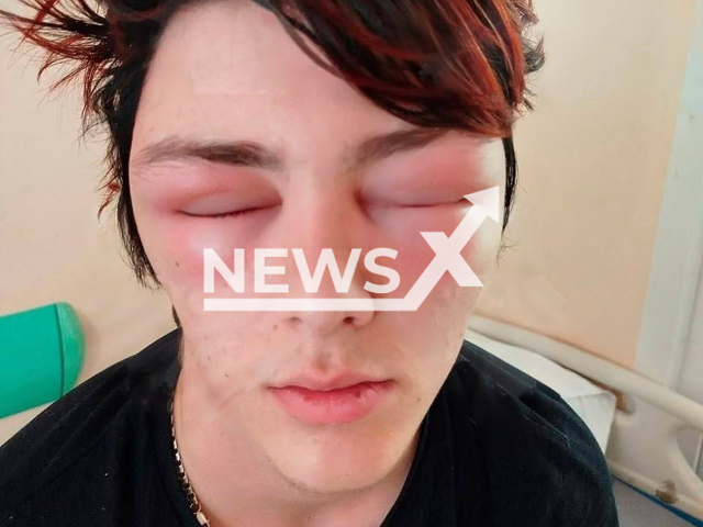 Photo shows the face with Quincke's edema of Daniil,15, from Moscow, Russia, undated. He suffered a severe allergic reaction after getting his hair dyed at a beauty salon. Note: Private photo taken from local media. (Newsflash)