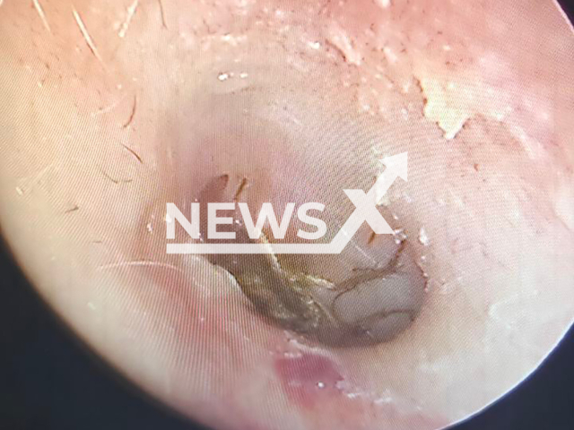 Photo shows a cockroach in the ear of female patient at the District Clinical Hospital in Vidnoye, Moscow Oblast, Russia on Wednesday, Sep. 11, 2024. The cockroach crawled into the ear canals while she was sleeping. Note: Licensed hospital photo. (@minzdrav_mo/Newsflash)